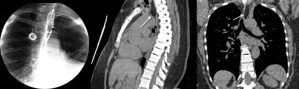 Esophageal Lipoma: A Rare Tumor
