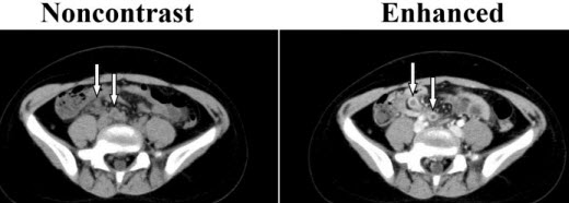 What is a CAT scan with contrast?