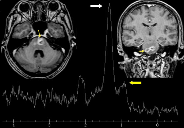 Radiation necrosis of the pons after radiotherapy for nasopharyngeal carcinoma: Diagnosis and treatment