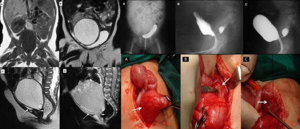 McKusick-Kaufman Syndrome: Atretic Upper Vaginal Pouch; an Unusual Urogenital MR Finding