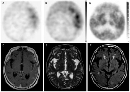 Detection of neoplastic meningitis in a patient with gastric cancer by thallium-201 SPECT