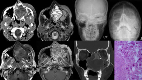 Cemento-ossifying Fibroma Of Paranasal Sinus Presenting Acutely  As Orbital Cellulitis