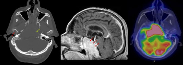 Expansive Masses Arising From The Clivus: The Role Of FDG-PET/CT In The Metabolic Assessment Of Skeletal Lesions