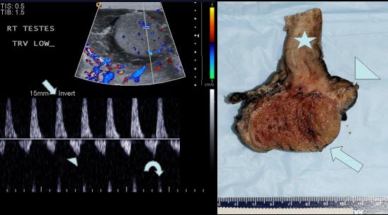 Significance of Reversal of Diastolic Blood Flow in the Evolution of Testicular Infarction as a Complication of Epididymo-Orchitis