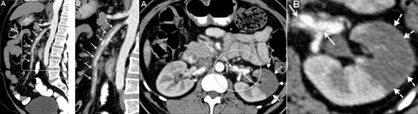 Spontaneous isolated superior mesenteric artery dissection  - Report of two cases