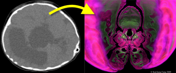 Lacuna Skull - The artistically rendered 3D computed tomography (CT) is shown to the right, resembling the appearance of an exotic orchid