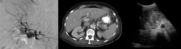 Successful Transcatheter Arterial Embolisation of a Cystic Artery Pseudoaneurysm Secondary to Calculus Cholecystitis: A Case Report