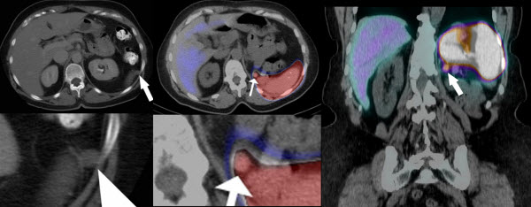 SPECT/CT imaging of a retroperitoneal nodule in a patient with history of infiltrating renal urothelial carcinoma