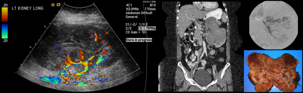 Renal neuroectodermal tumour presenting with hematuria