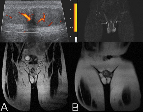 Supernumerary Testis
