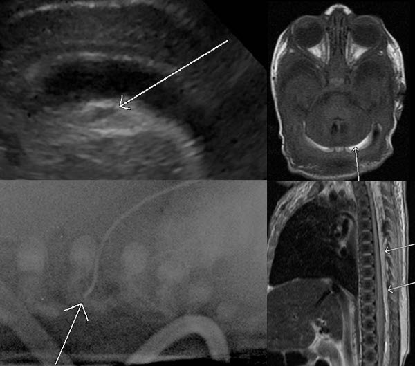 Lipid Infusion Through Malpositioned Central Venous Catheter: Head Ultrasound Features