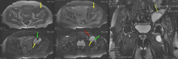 An atypical case of noninfected iliopsoas bursitis - MRI findings