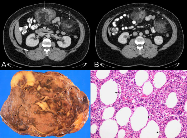 icd 10 bilateral adrenal nodules
