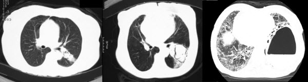 Chronic pulmonary aspergillosis - longterm follow-up over 20 years, a case report
