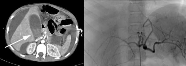 Blunt abdominal trauma - An important cause of portal venous pseuodoaneurysm