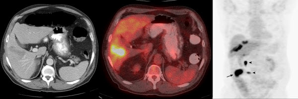 FDG PET/CT diagnosis of hepatic lymphoma mimicking focal fatty infiltration on CT