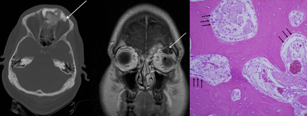 Osteoblastoma of the Frontal Sinuses Presenting with Headache and Blurred Vision: Case Report and Review of the Literature