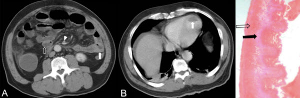 Acute Mesenteric Ischaemia on Unenhanced Computer-Tomography