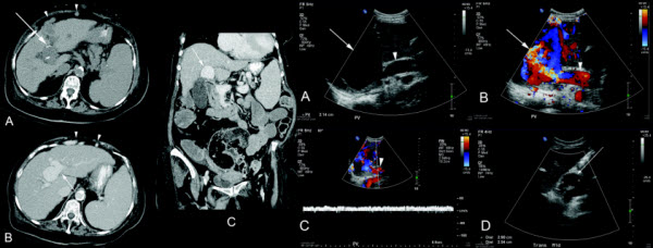 Portal Vein Aneurysms: A Case Series with Literature Review