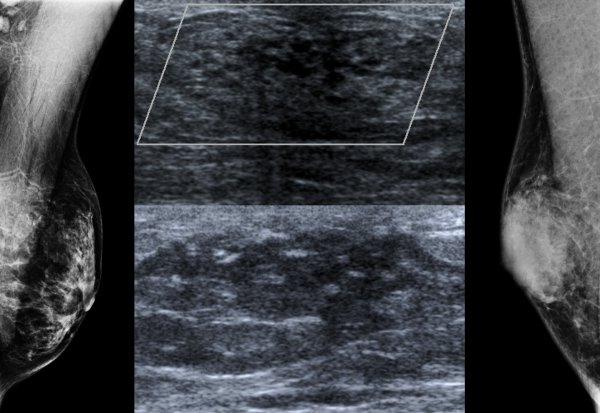 Gynaecomastia associated with highly active antiretroviral therapy (HAART)
