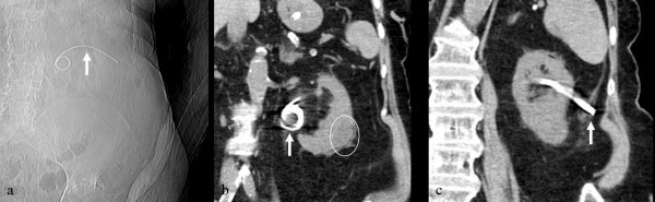 Percutaneous transrenal retrieval of fractured nephrostomy tube under fluoroscopic guidance