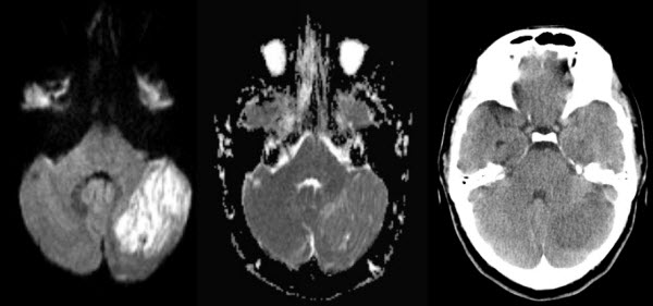 Coexisting MS and Lhermitte-Duclos Disease