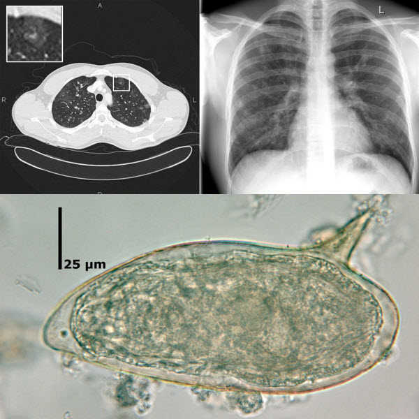Pulmonary Schistosomiasis – Imaging Features
