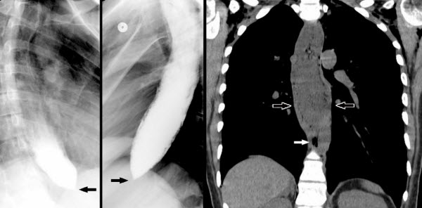 Spontaneous Pneumomediastinum Due to Achalasia: An Unusual but Benign Cause