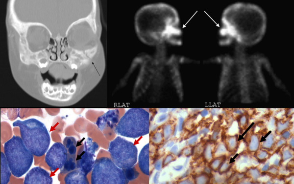 Hyperostosis - an unusual radiographic presentation of Myelodysplastic Syndrome transformed to Acute Myeloid Leukemia