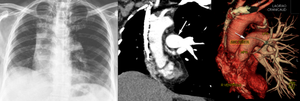 Incidentally detected unilateral pulmonary artery agenesis with pulmonary hypoplasia in a 67 year old woman