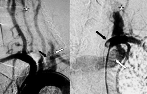 neck fistula