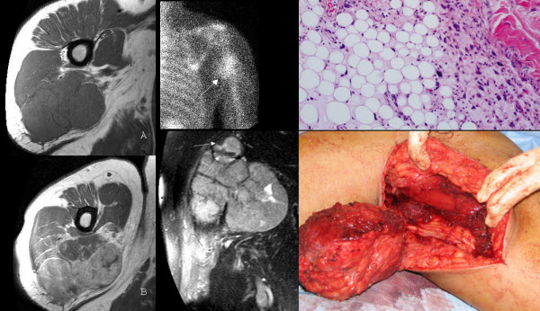 Primary Dedifferentiated Liposarcoma of the Axilla Arising in a Mixed, Well-differentiated and Myxoid Liposarcoma
