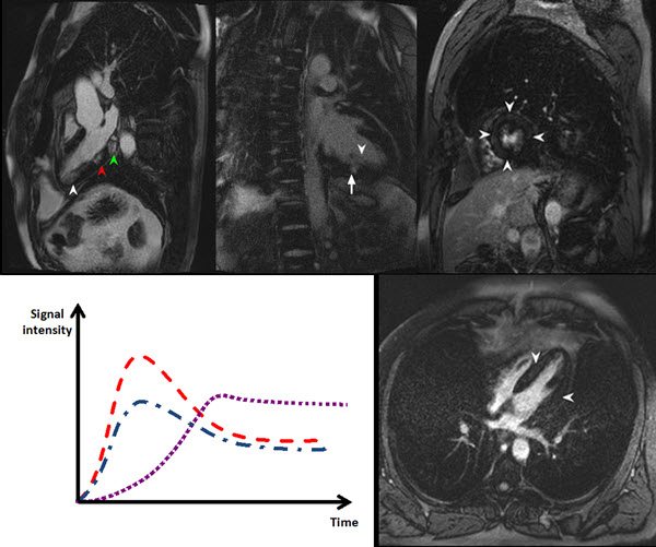Delayed Myocardial Enhancement in Cardiac Resonance Imaging