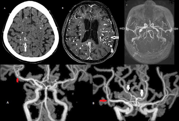 diffuse-proliferative-cerebral-angiopathy-a-case-report-and-review-of