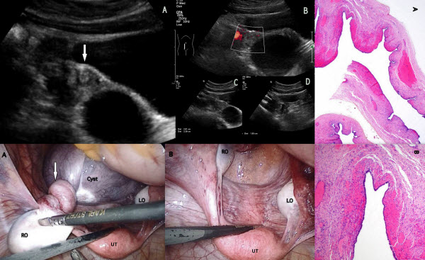 Isolated Fallopian Tube Torsion With Fimbrial Cyst In A 10 Year-old Girl Diagnosed By Ultrasound: A Case Report