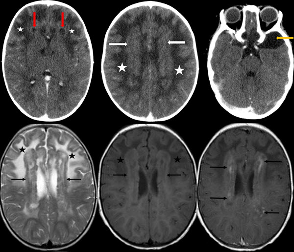 MRI diagnosis of infantile Alexander disease in a 14 month ...