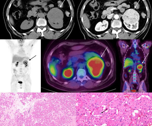 Oncocytoma: A Differential Consideration for an Incidentally Detected ...