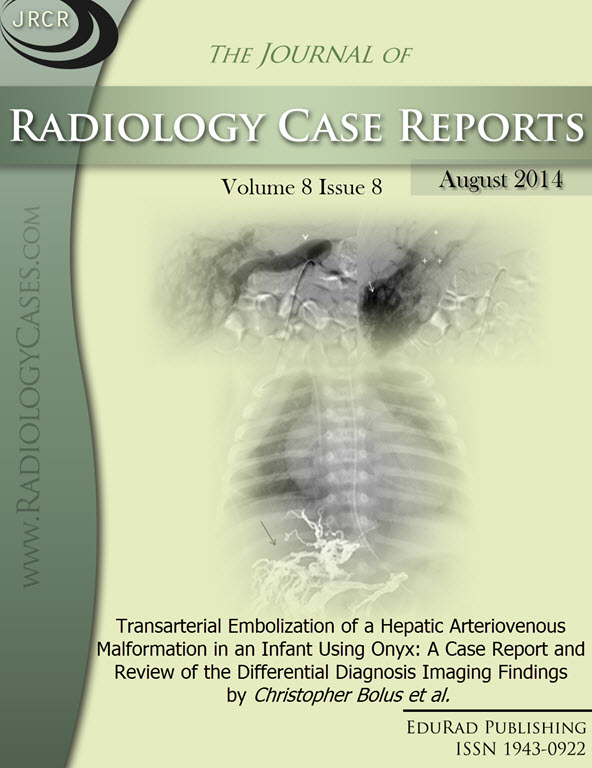 Journal of Radiology Case Reports August 2014 issue - Cover page: Transarterial Embolization of a Hepatic Arteriovenous Malformation in an Infant Using Onyx: A Case Report and Review of the Differential Diagnosis Imaging Findings by Christopher Bolus et a