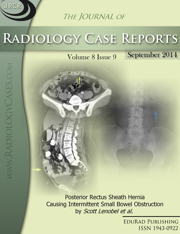 Journal of Radiology Case Reports September 2014 issue - Cover page: Posterior Rectus Sheath Hernia Causing Intermittent Small Bowel Obstruction by Scott Lenobel et al.