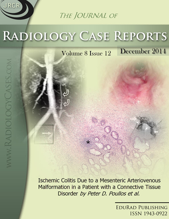 Journal of Radiology Case Reports December 2014 issue - Cover page: Ischemic Colitis Due to a Mesenteric Arteriovenous Malformation in a Patient with a Connective Tissue Disorder by Peter D. Poullos et. al.