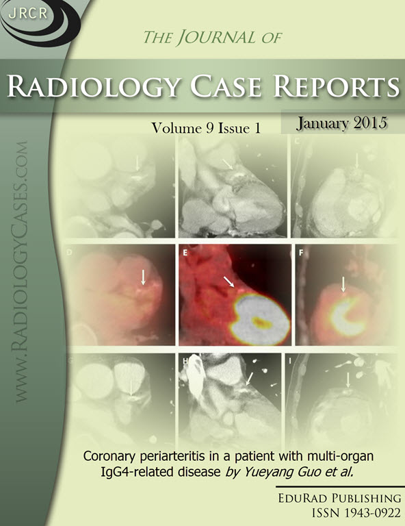 Journal of Radiology Case Reports January 2015 issue - Cover page: Coronary periarteritis in a patient with multi-organ IgG4-related disease by Yueyang Guo et al.