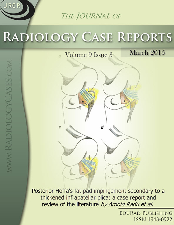Journal of Radiology Case Reports March 2015 issue - Cover page: Posterior Hoffa's fat pad impingement secondary to a thickened infrapatellar plica: a case report and review of the literature by Arnold Radu et al.