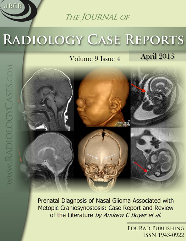 Journal of Radiology Case Reports April 2015 issue - Cover page: Prenatal Diagnosis of Nasal Glioma Associated with Metopic Craniosynostosis: Case Report and Review of the Literature by Andrew C Boyer et al.