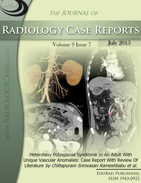 Journal of Radiology Case Reports July 2015 issue - Cover page: Heterotaxy Polysplenia Syndrome In An Adult With Unique Vascular Anomalies: Case Report With Review Of Literature by Chittapuram Srinivasan Rameshbabu et al.