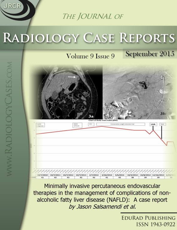 Journal of Radiology Case Reports September 2015 issue - Cover page: Minimally invasive percutaneous endovascular therapies in the management of complications of non-alcoholic fatty liver disease (NAFLD):  A case report by Jason Salsamendi