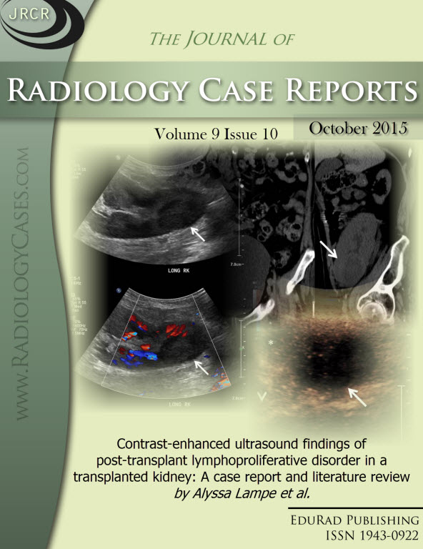Journal of Radiology Case Reports October 2015 issue - Cover page: Contrast-enhanced ultrasound findings of post-transplant lymphoproliferative disorder in a transplanted kidney: A case report and literature review by Alyssa Lampe et al.