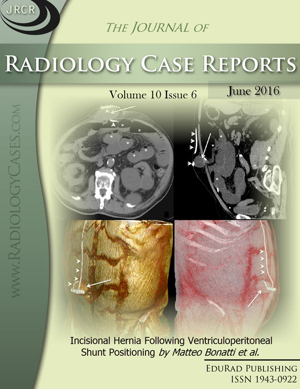 Journal of Radiology Case Reports June 2016 issue - Cover page: Incisional Hernia Following Ventriculoperitoneal Shunt Positioning by Matteo Bonatti et al.