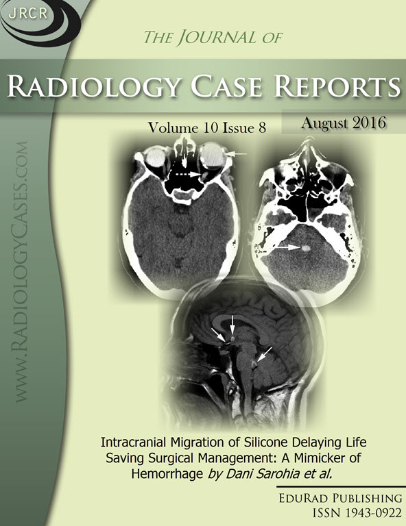 Journal of Radiology Case Reports August 2016 issue - Cover page: Intracranial Migration of Silicone Delaying Life Saving Surgical Management: A Mimicker of Hemorrhage by Dani Sarohia et al.