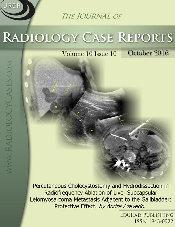 Journal of Radiology Case Reports October 2016 issue - Cover page: Percutaneous Cholecystostomy and Hydrodissection in Radiofrequency Ablation of Liver Subcapsular Leiomyosarcoma Metastasis Adjacent to the Gallbladder: Protective Effect. by André Azevedo.