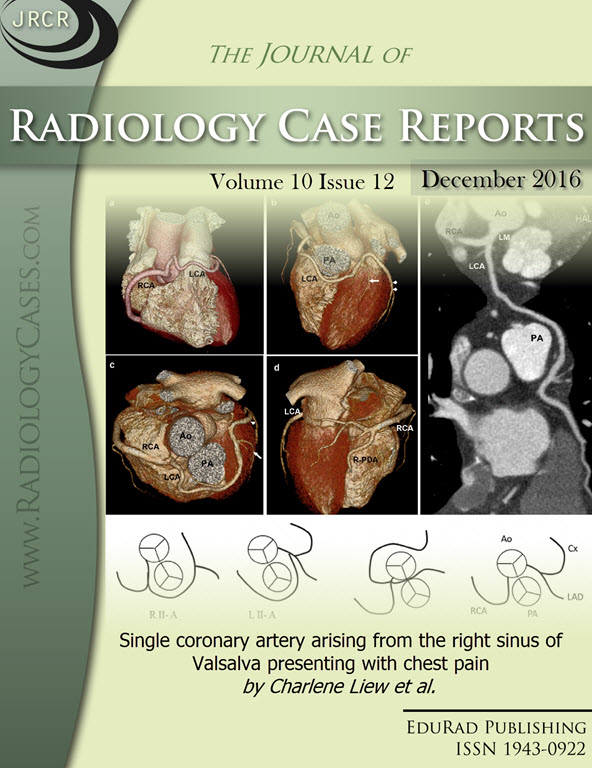 Single coronary artery arising from the right sinus of Valsalva presenting with chest pain by Charlene Liew et al.